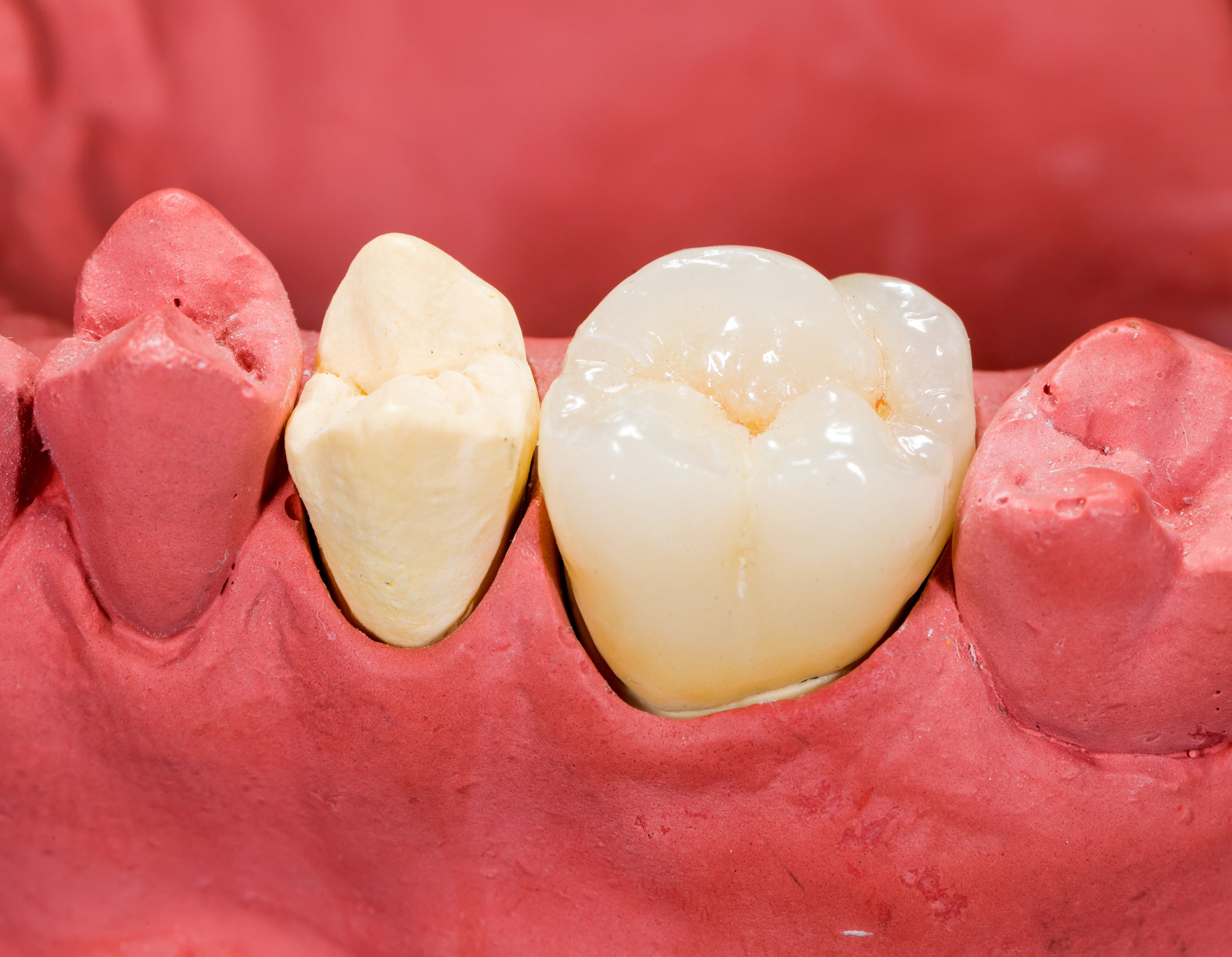 Konzervativa zoba in kako sem spoznala, da popravilo ni le plomba